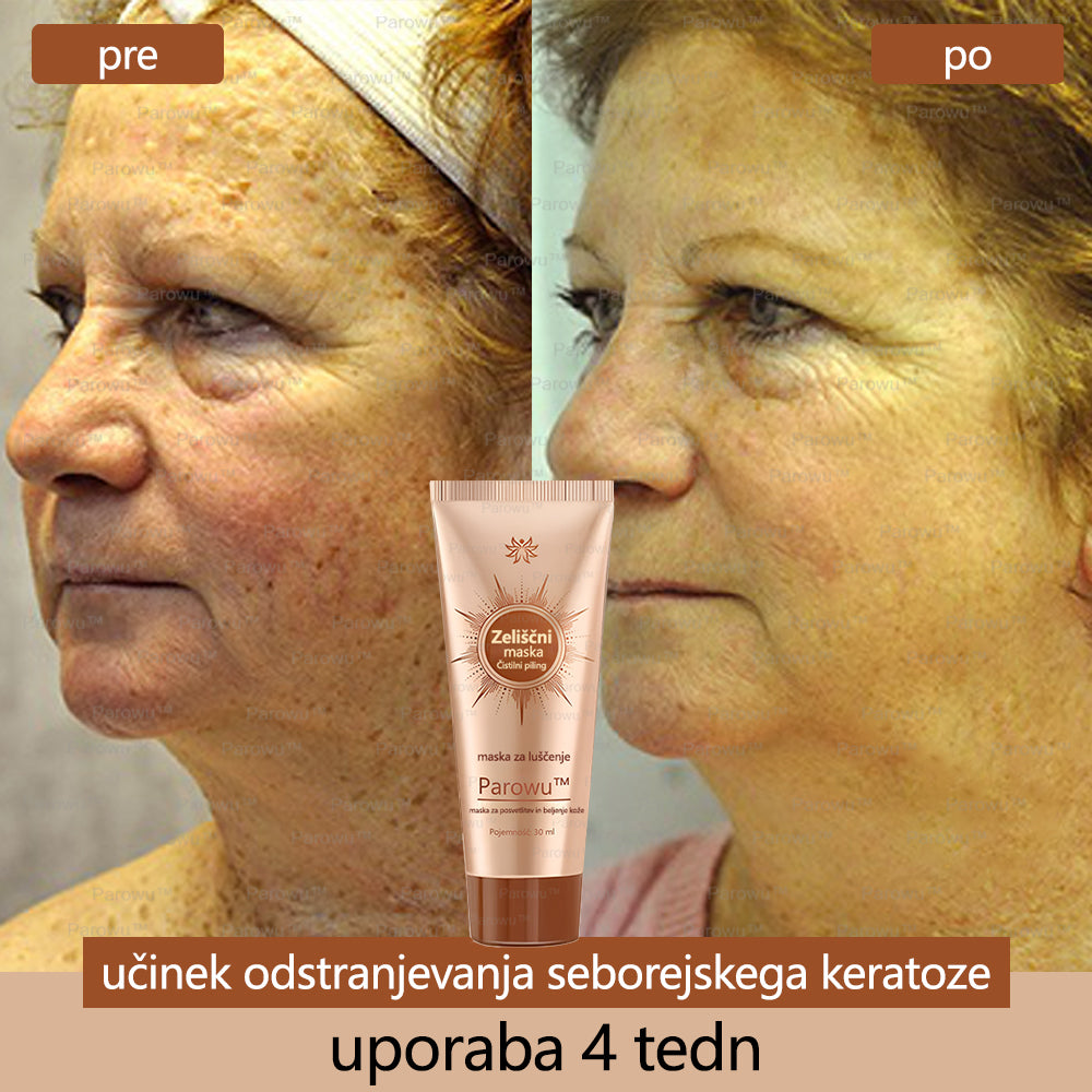Parowu™ Belilna in Odstranjevalna Maska za madeže - 🍀 Naravne sestavine trajno odstranjujejo pigmentne madeže, starostne pege, pegice in sončne madeže 🔥