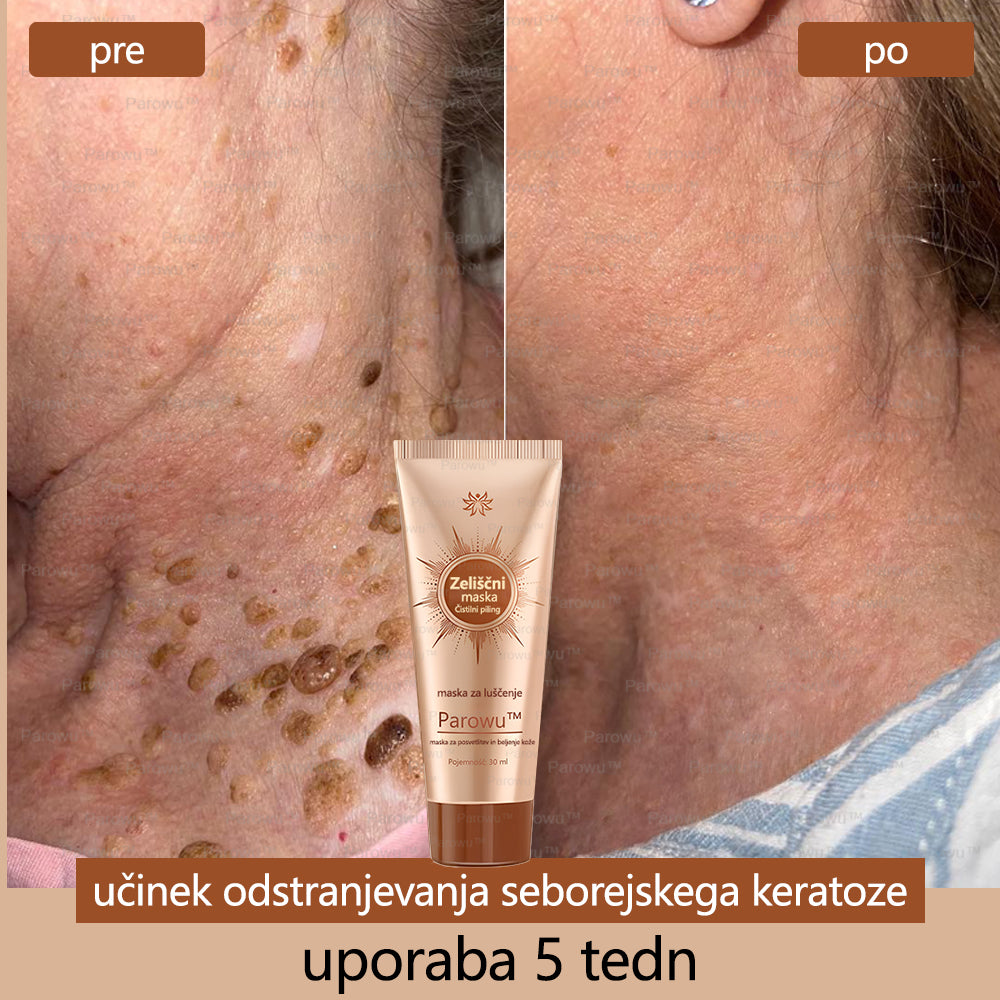 Parowu™ Belilna in Odstranjevalna Maska za madeže - 🍀 Naravne sestavine trajno odstranjujejo pigmentne madeže, starostne pege, pegice in sončne madeže 🔥