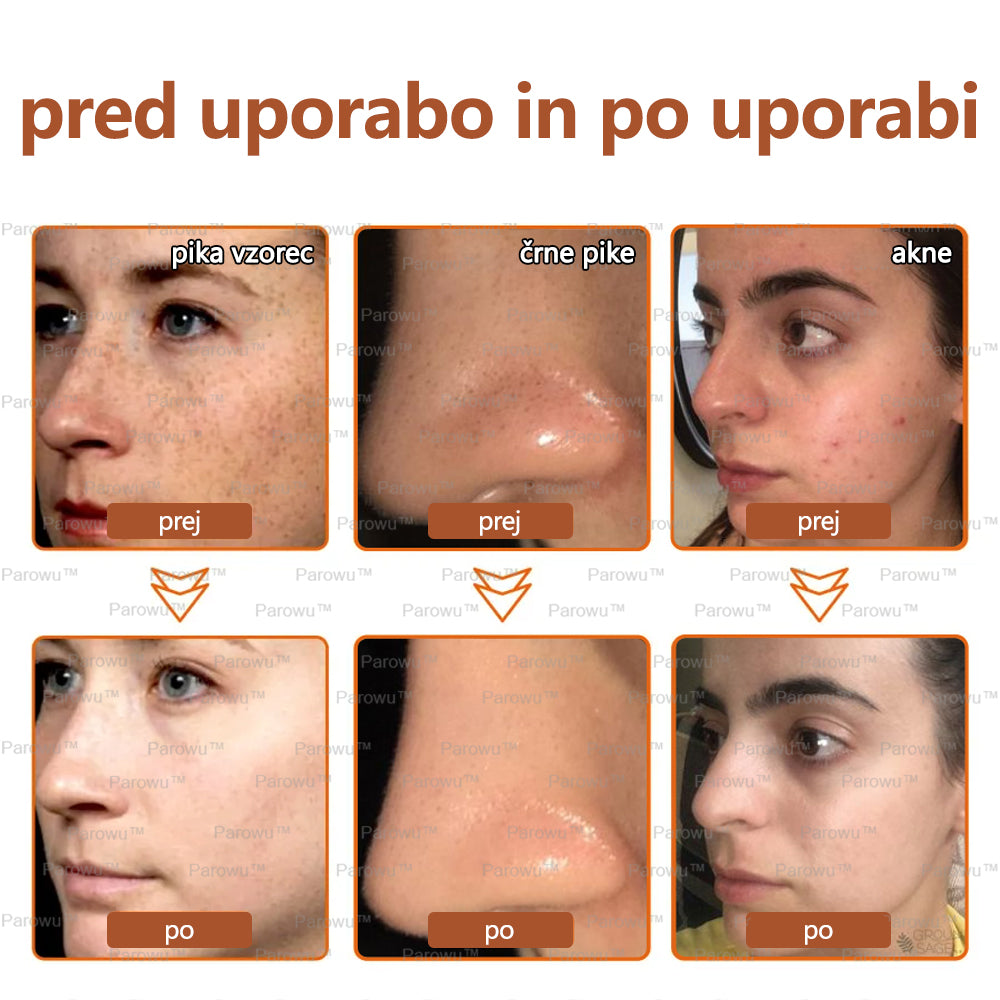 Parowu™ Belilna in Odstranjevalna Maska za madeže - 🍀 Naravne sestavine trajno odstranjujejo pigmentne madeže, starostne pege, pegice in sončne madeže 🔥