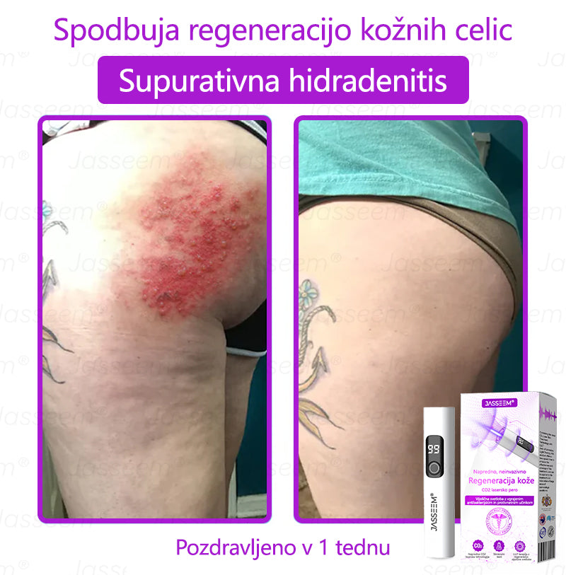 𝐉𝐚𝐬𝐬𝐞𝐞𝐦® Napredni neinvazivni CO₂ laserski pisalo za obnovo kože 🛫 (Nežno odstrani bradavice, materina znamenja, starostne pege in kožne izrastke – brez bolečin in brez kompliciranja!)