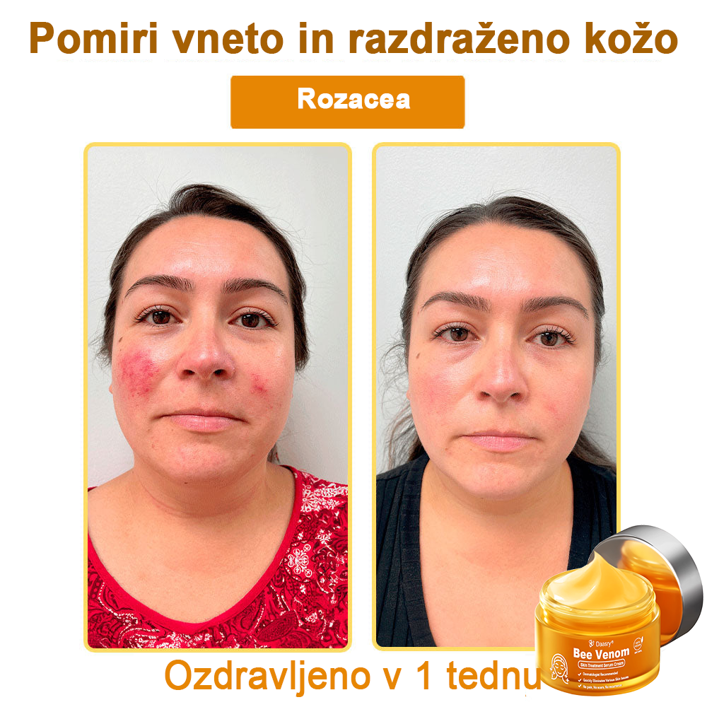 Daasry® Cebelji Strup Kožna Terapija Serum Krema👨⚕️ (Primerno za vse starosti & priporočeno s strani EMA)