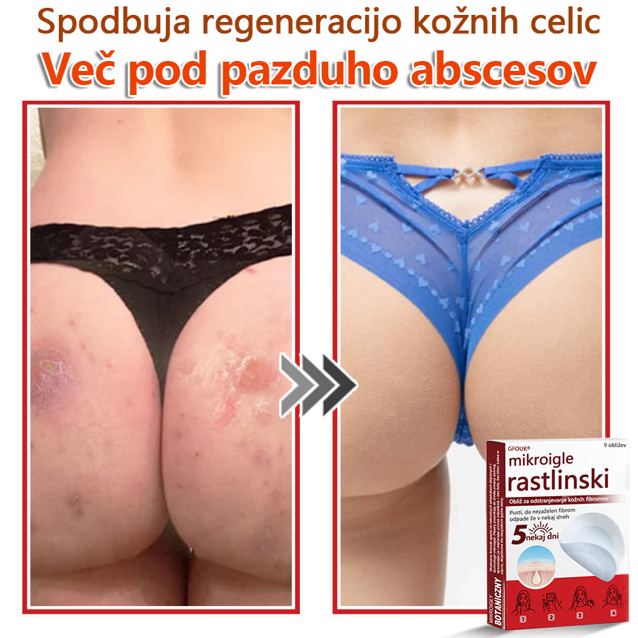👨⚕️ GFOUK® MicroNeedle obliž za odstranjevanje kožnih izrastkov 🇪🇺 Skupno z EU smernicami za nego kože