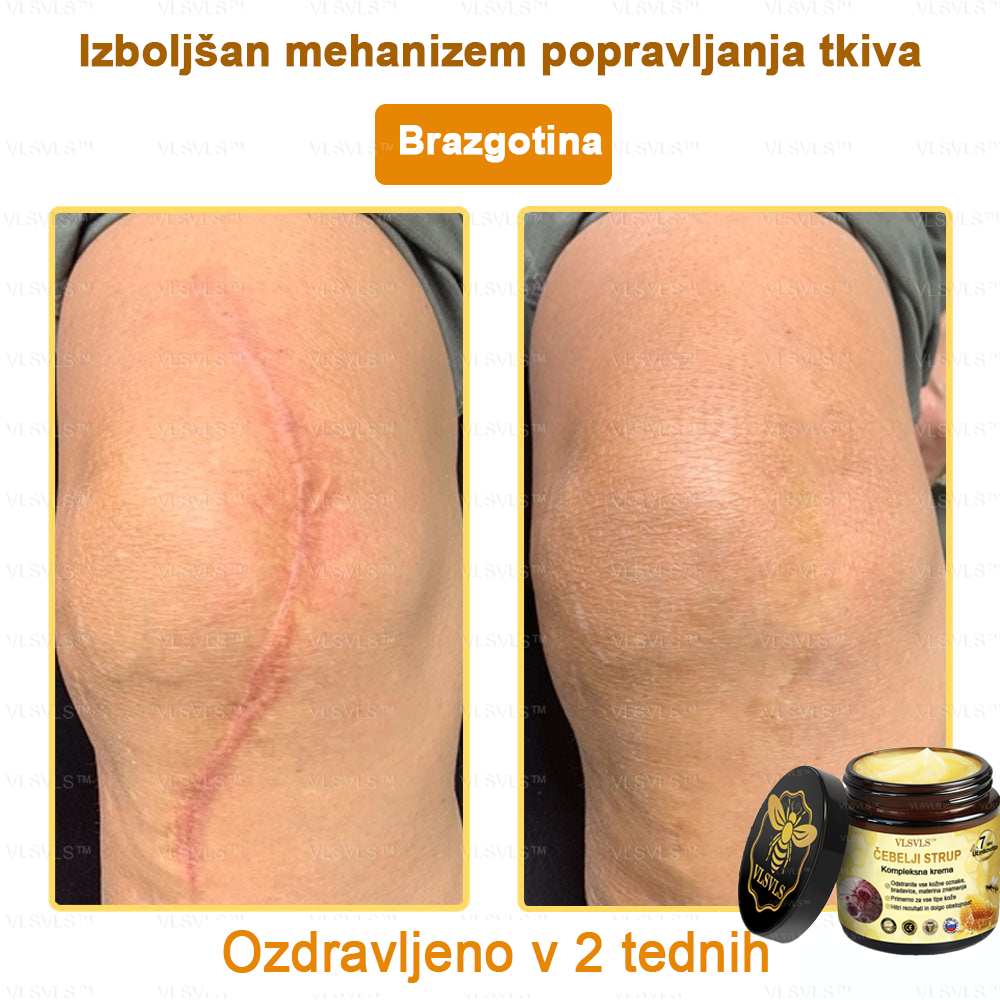VLSVLS™ krema s čebeljim strupom s polnim učinkom 🧑⚕️ Priporočajo dermatologi - za zdravljenje različnih kožnih težav🐝