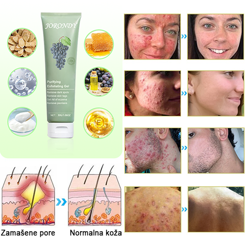 Čistilni piling gel za Acanthosis Nigricans, luščenje, temne madeže, kožne oznake in ekceme