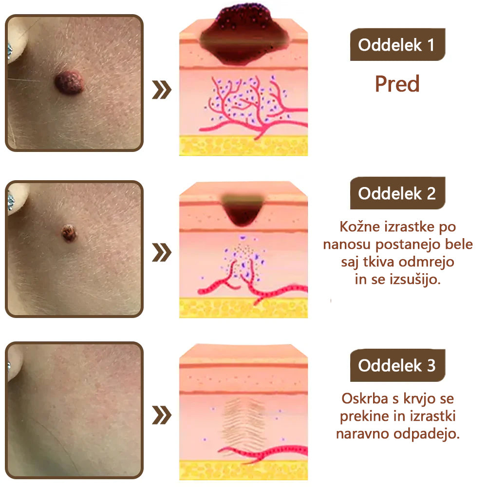 Zvoevo® Black Rice Skin Repair Essence Cream ⚕️ Certificirano pri EU (Odstranjuje bradavice in kožne izrastke, lajša luskavico, izboljšuje kopičenje keratina in folikularno keratinizacijo, posvetli pigmentacijo, sončne pege in starostne pege)