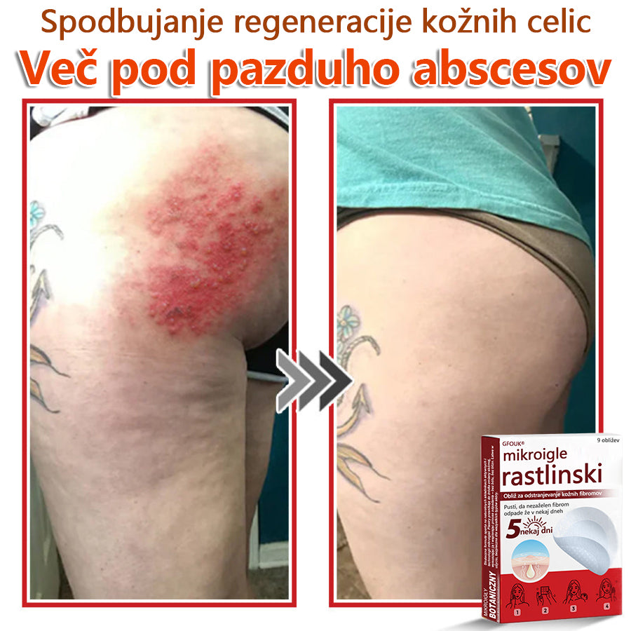 👨⚕️ GFOUK® MicroNeedle obliž za odstranjevanje kožnih izrastkov 🇪🇺 Skupno z EU smernicami za nego kože