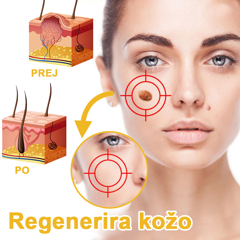 ✨🎁𝑭𝑹𝑶𝑷𝑼𝑵™ krema za odstranjevanje znamenj in madežev (85% popust zadnji dan dogodka)