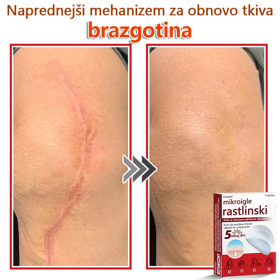 👨⚕️ GFOUK® MicroNeedle obliž za odstranjevanje kožnih izrastkov 🇪🇺 Skupno z EU smernicami za nego kože