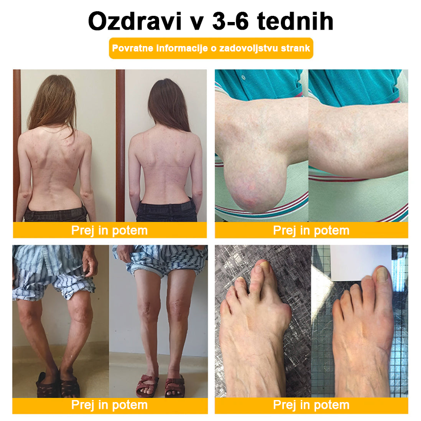 ADNOON™ Krema za lajšanje bolečin in celjenje kosti z botulin toksinom in čebeljim strupom