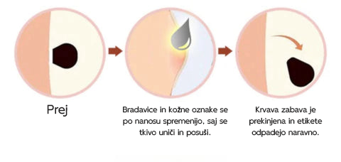 🐝 Krema Lenaro™ za zdravljenje madežev in bradavic 💎💎💎Primerna za vse starostne kategorije🐝