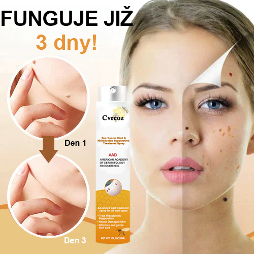 🐝🐝Cvreoz™ sprej za odstranjevanje bradavic in znamenj 🐝🐝🐝 (🔥Poslednja promocija 80% popust)