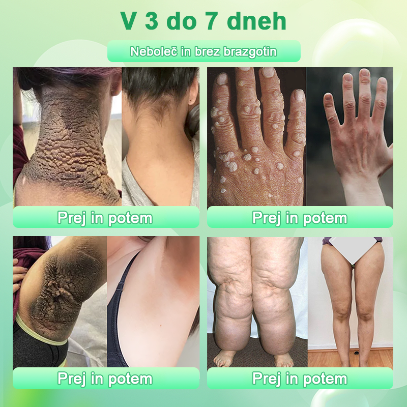 Čistilni piling gel za Acanthosis Nigricans, luščenje, temne madeže, kožne oznake in ekceme