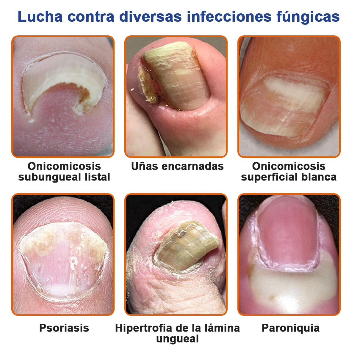 🐝🐝𝐅𝐮𝐫𝐳𝐞𝐫𝐨™Bienengift Nagelpilz Tretma: Popolna rešitev problema glivic na nohtih🌟👣