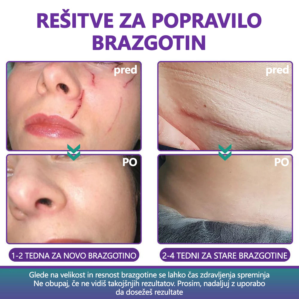 🏷️ Uradna Trgovina: flysmus® ReGen Mikronadlaste Ploščice z Nano-Hialuronsko Kislino (Nano-Heal) 💝 Zdravljenje novih in starih brazgotin, zmanjševanje kirurških brazgotin, strij, keloidov, aken, opeklin, bradavic, dermatomov in krčnih žil