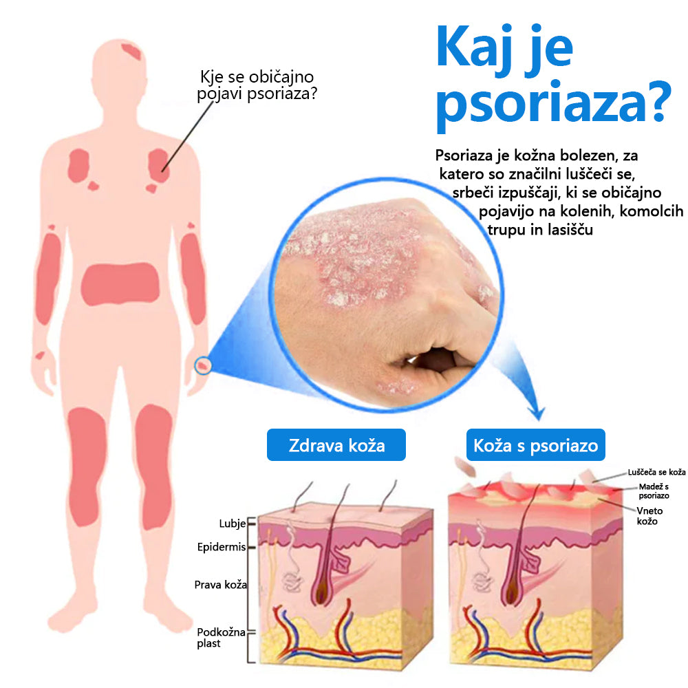 ✅ Uradna trgovina: Zvoevo® Magnezijev zeliščni sprej za luskavico ⚕️ EMA certificirano (lajša luskavico in ekcem, izboljšuje bakterijske okužbe na genitalnem področju, zdravi akne in bradavice, lajša bolečine v sklepih in nevropatske bolečine)