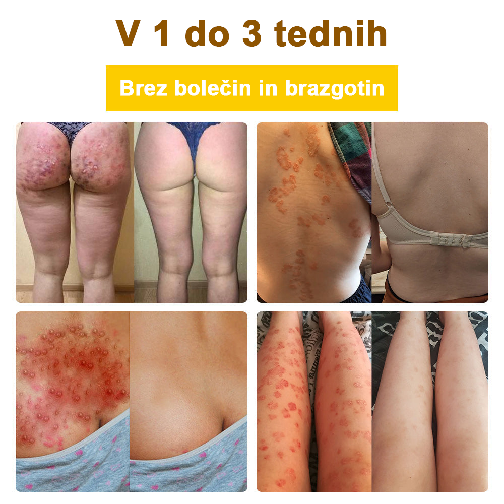 ✅flysmus™ zdravilna krema s čebeljim strupom🐝: Zdravljenje ekcemov, luskavice, aken, rozacee, glivičnih okužb, bradavic