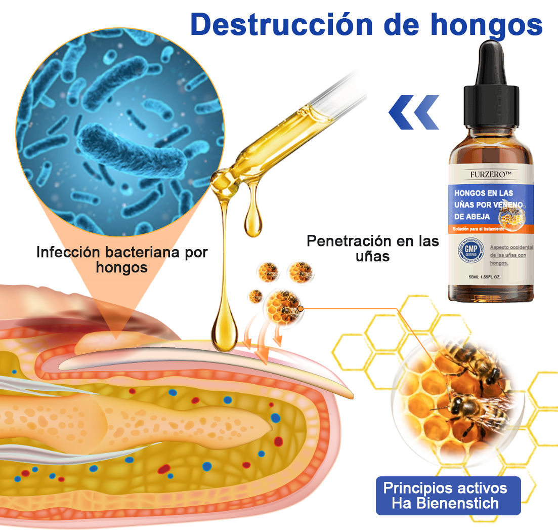 🐝🐝𝐅𝐮𝐫𝐳𝐞𝐫𝐨™Bienengift Nagelpilz Tretma: Popolna rešitev problema glivic na nohtih🌟👣