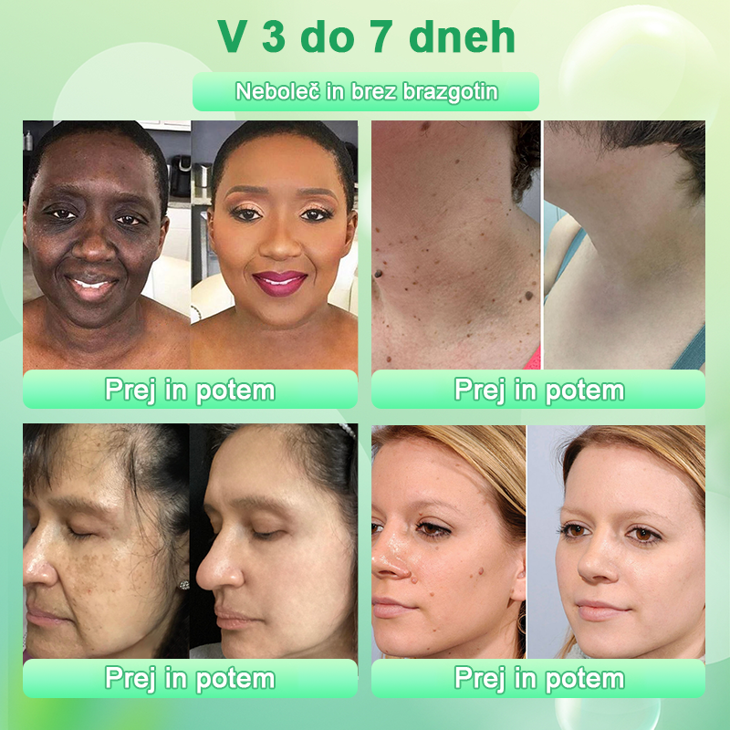 Čistilni piling gel za Acanthosis Nigricans, luščenje, temne madeže, kožne oznake in ekceme
