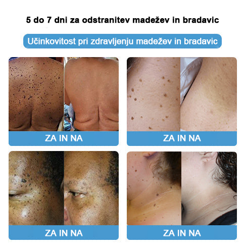 🐝 Krema Lenaro™ za zdravljenje madežev in bradavic 💎💎💎Primerna za vse starostne kategorije🐝