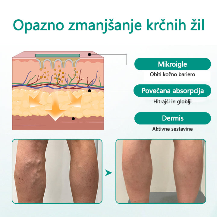 Timilk® LegRenew obliž za krčne žile izboljša zdravje ven in odpravi krčne žile – brez operacije