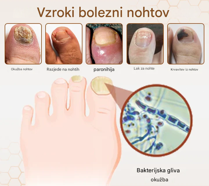 💥 2025 Omejeno 70 % CENEJE ️⏳ Ceoerty® NailRescue Kolirin pršilo proti glivicam s čebeljim strupom 💥 Vse težave z nohti lahko pozdravite v 2 tednih