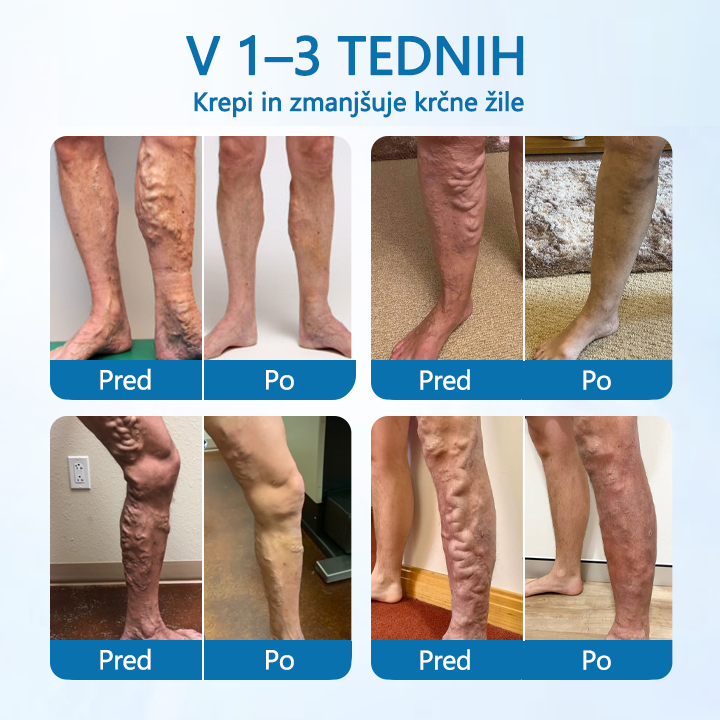 💚Trimil® VeinGuard zeliščni sprej – ✅ Klinično dokazano, da odpravi krčne žile že v 7 dneh! (potrjeno s strani Evropske agencije za zdravila – EMA)