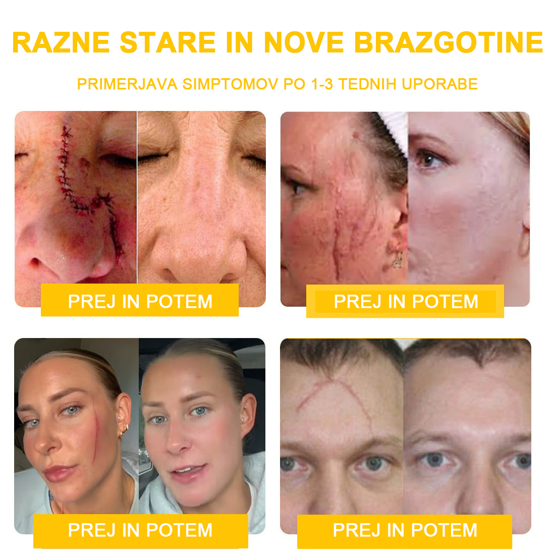 𝑽𝒆𝒍𝒊𝒔𝒔𝒆™ 2024 (priporoča AAD), za odstranjevanje bradavic, aken in brazgotin. Zdravi različne kožne bolezni