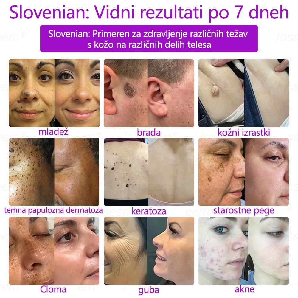 𝐉𝐚𝐬𝐬𝐞𝐞𝐦® Napredni neinvazivni CO₂ laserski pisalo za obnovo kože 🛫 (Nežno odstrani bradavice, materina znamenja, starostne pege in kožne izrastke – brez bolečin in brez kompliciranja!)