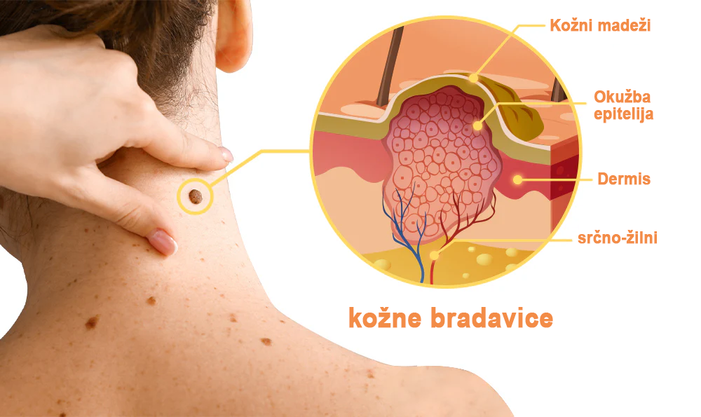 ✨𝐙𝐨𝐞𝐧𝐜𝐠𝐳™ krema s čebeljim strupom za znamenja in bradavice🔥