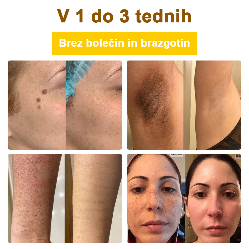 ✅flysmus™ zdravilna krema s čebeljim strupom🐝: Zdravljenje ekcemov, luskavice, aken, rozacee, glivičnih okužb, bradavic