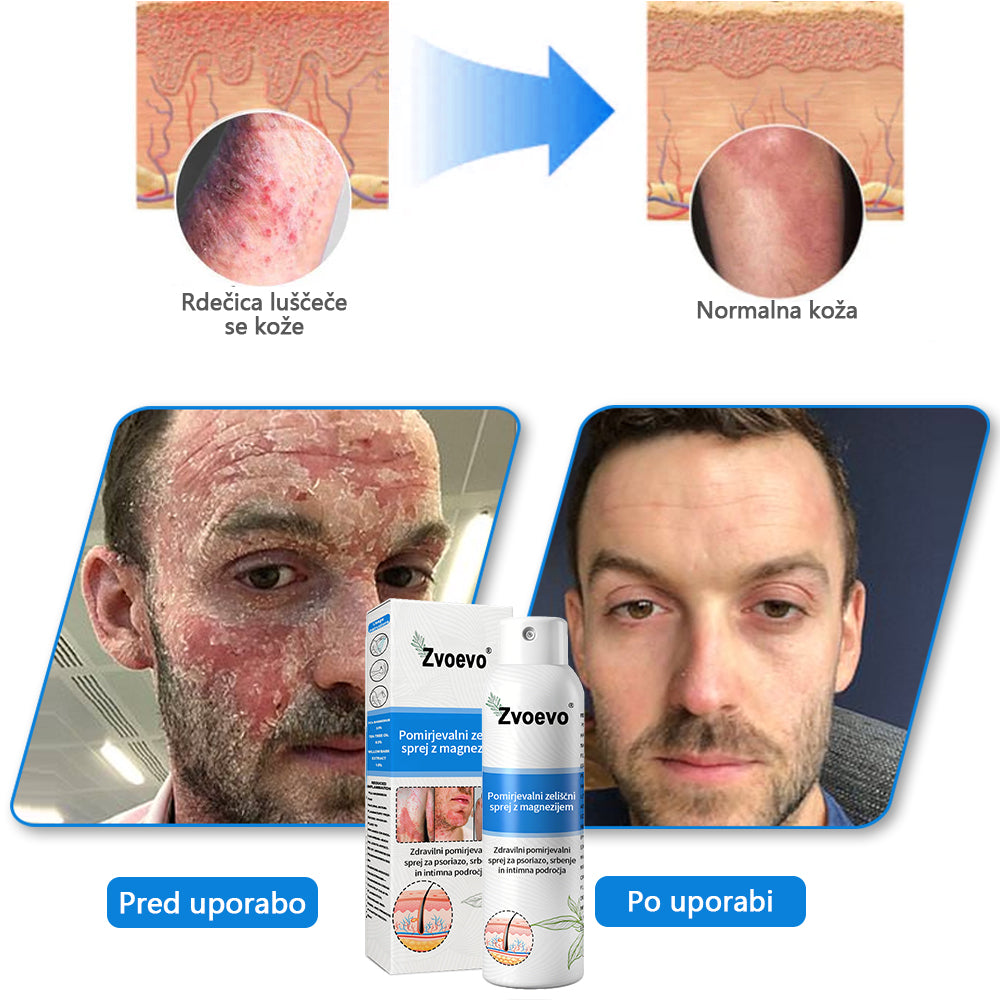 ✅ Uradna trgovina: Zvoevo® Magnezijev zeliščni sprej za luskavico ⚕️ EMA certificirano (lajša luskavico in ekcem, izboljšuje bakterijske okužbe na genitalnem področju, zdravi akne in bradavice, lajša bolečine v sklepih in nevropatske bolečine)