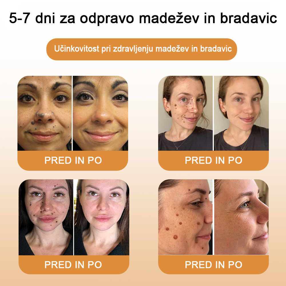 🌺𝙒𝙍𝙀𝙀™ Krema za odstranjevanje bradavic in oznak s čebeljim strupom (👨⚕Primerna za vse tipe kože)🐝(🔥Promocija zadnji dan 70% popust)