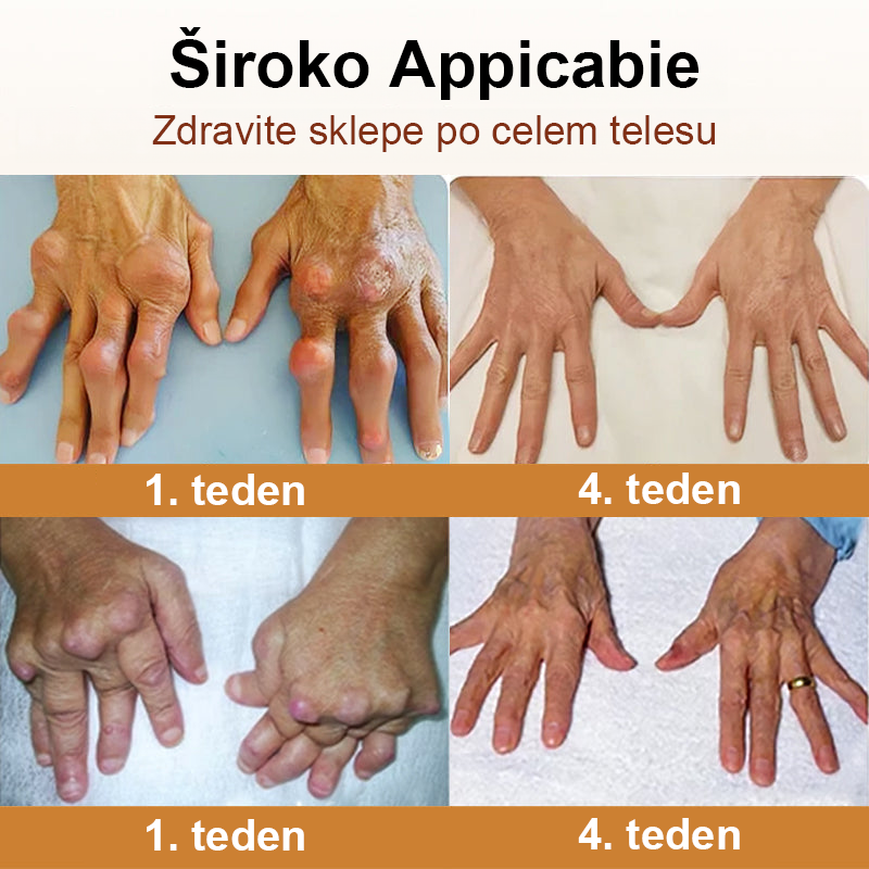 🌿TODAHOF™ Sprej za sklepe s čebeljim strupom💎Primeren za vse starosti🔥 Časovno omejen 75% popust