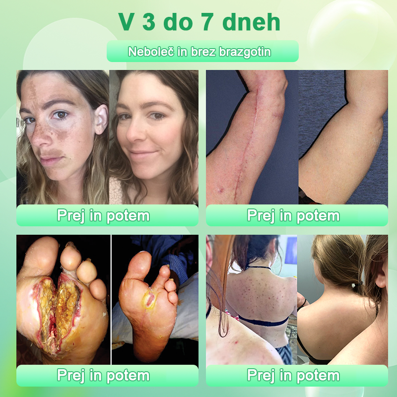 Čistilni piling gel za Acanthosis Nigricans, luščenje, temne madeže, kožne oznake in ekceme