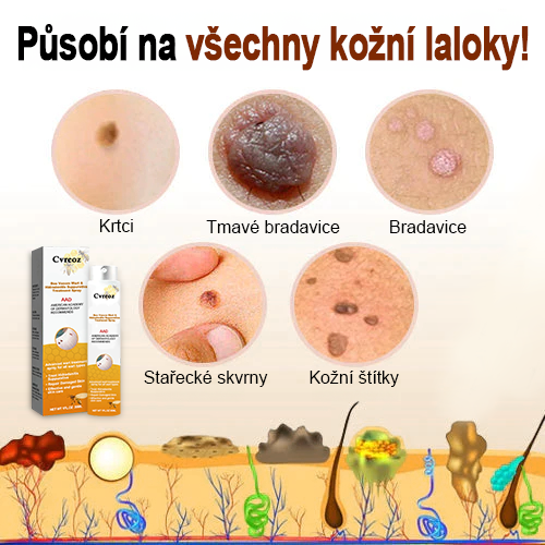 🐝🐝Cvreoz™ sprej za odstranjevanje bradavic in znamenj 🐝🐝🐝 (🔥Poslednja promocija 80% popust)