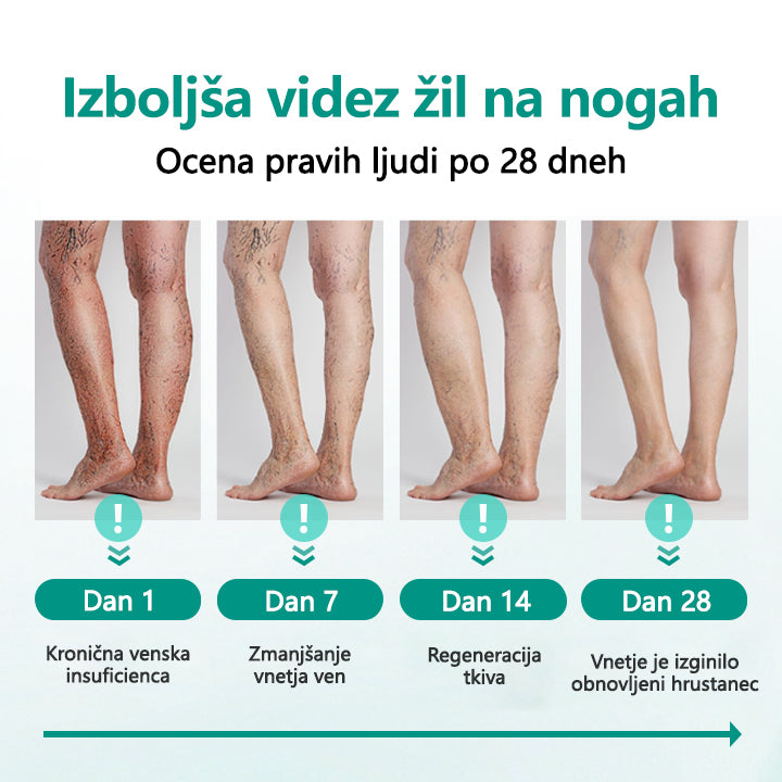 Timilk® LegRenew obliž za krčne žile izboljša zdravje ven in odpravi krčne žile – brez operacije