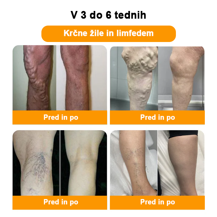 𝐀𝐞𝐞𝐡𝐟𝐞𝐧𝐠™ 𝐙𝐞𝐥𝐢šč𝐧𝐞 𝐫𝐚𝐳𝐬𝐭𝐫𝐮𝐩𝐥𝐣𝐞𝐯𝐚𝐥𝐧𝐞 𝐤𝐫𝐨𝐠𝐥𝐢𝐜𝐞 𝐳𝐚 𝐯𝐞𝐧𝐞 𝐳𝐚 𝐤𝐨𝐩𝐞𝐥 𝐧𝐨𝐠🦵👩⚕️ (LANA Certification, European Lymphology Association)