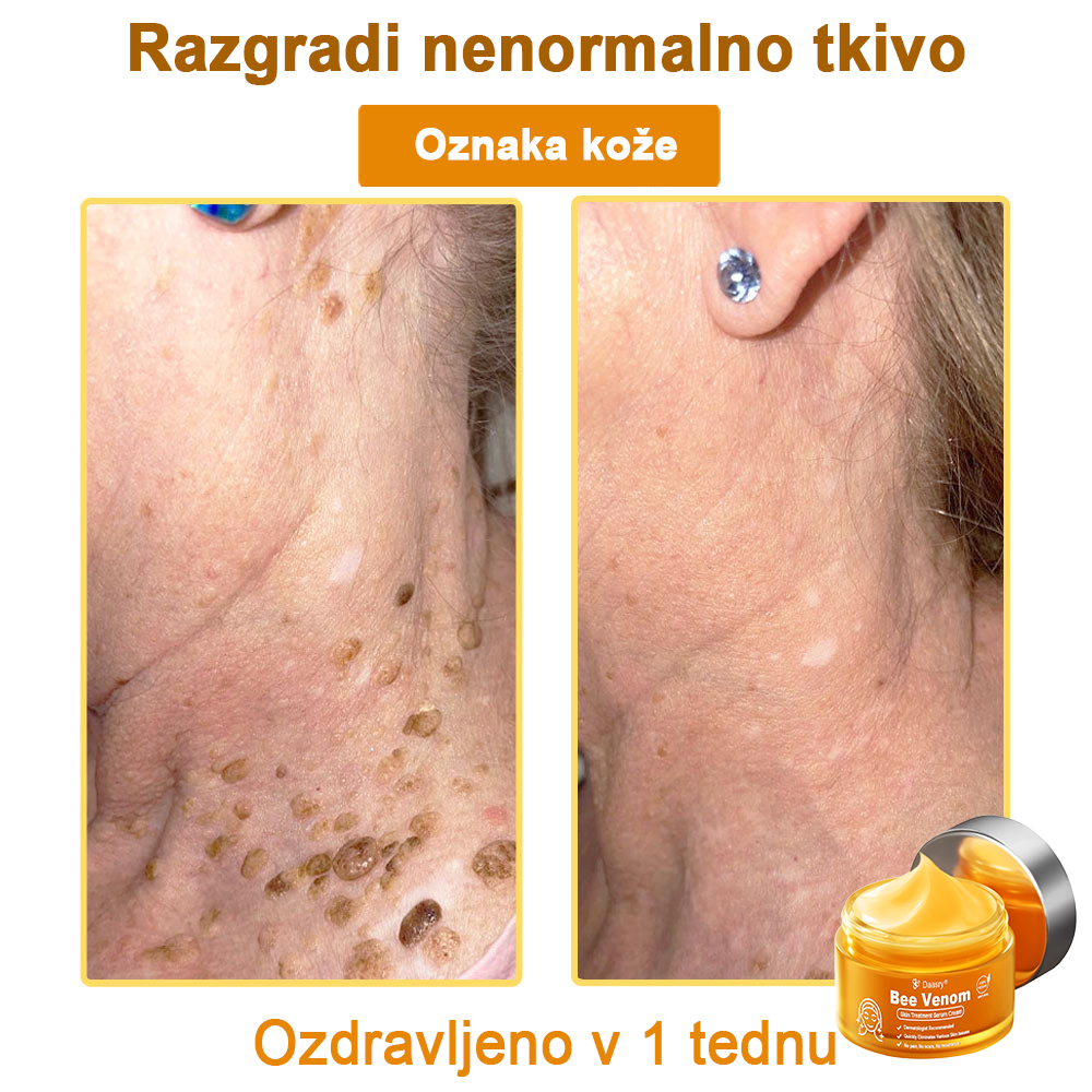 Daasry® Cebelji Strup Kožna Terapija Serum Krema👨⚕️ (Primerno za vse starosti & priporočeno s strani EMA)