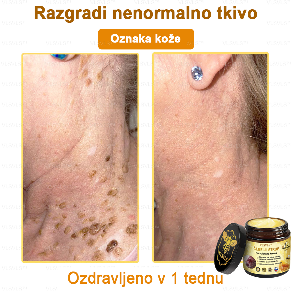 VLSVLS™ krema s čebeljim strupom s polnim učinkom 🧑⚕️ Priporočajo dermatologi - za zdravljenje različnih kožnih težav🐝