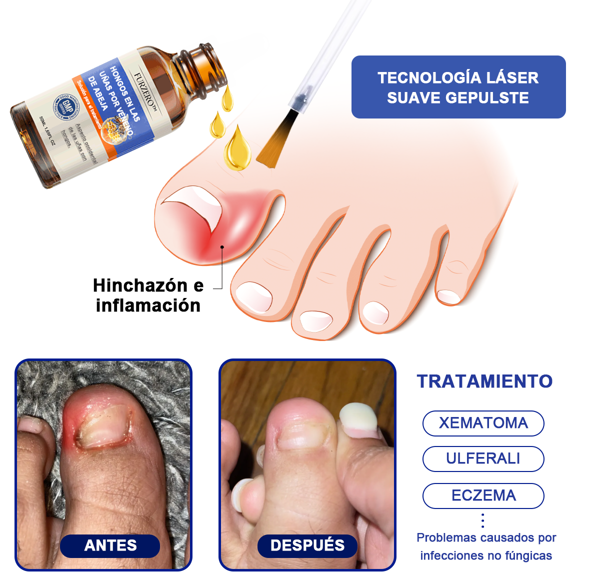 🐝🐝𝐅𝐮𝐫𝐳𝐞𝐫𝐨™Bienengift Nagelpilz Tretma: Popolna rešitev problema glivic na nohtih🌟👣
