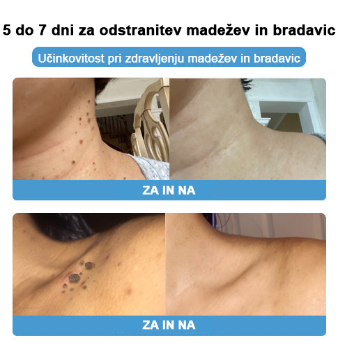 🐝 Krema Lenaro™ za zdravljenje madežev in bradavic 💎💎💎Primerna za vse starostne kategorije🐝
