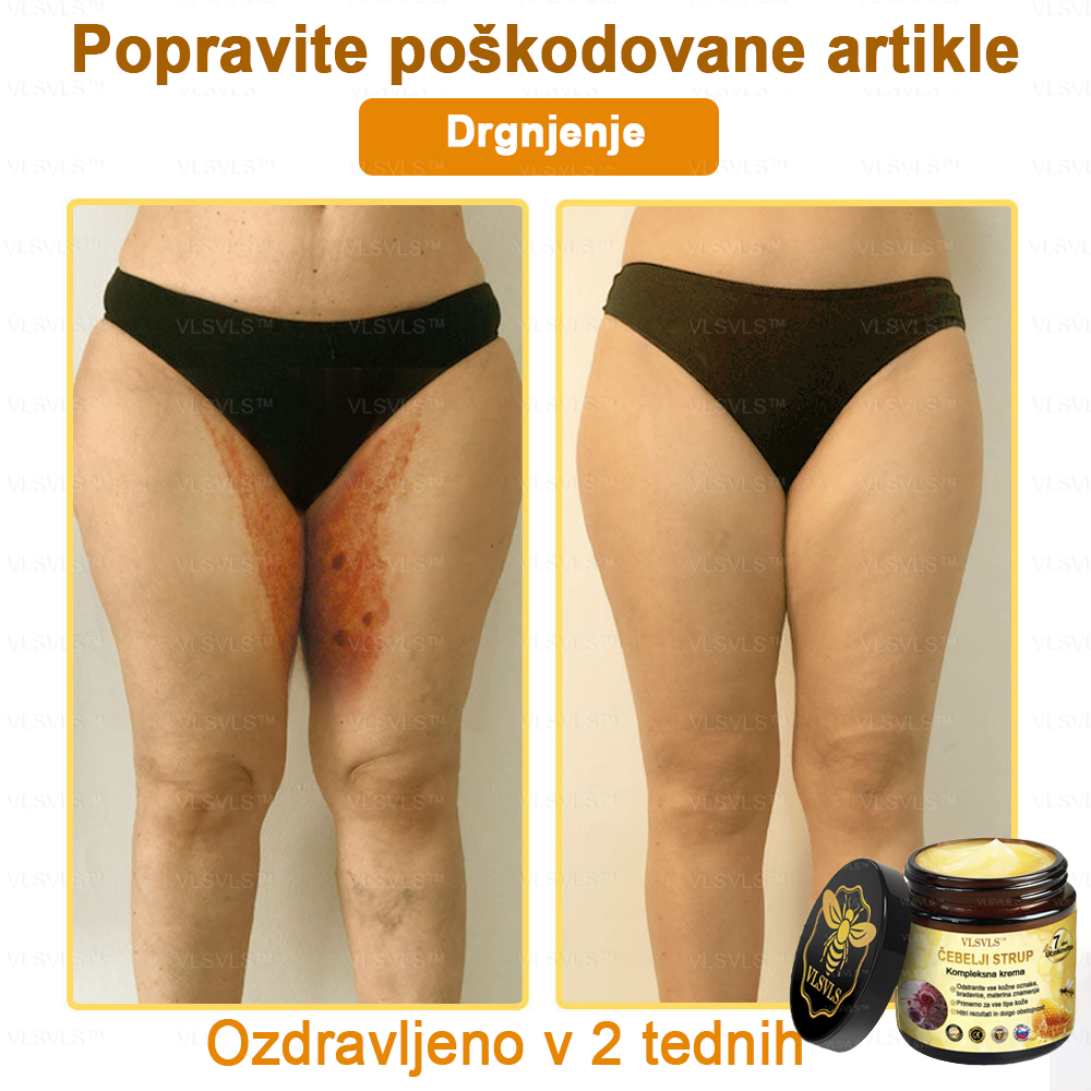VLSVLS™ krema s čebeljim strupom s polnim učinkom 🧑⚕️ Priporočajo dermatologi - za zdravljenje različnih kožnih težav🐝