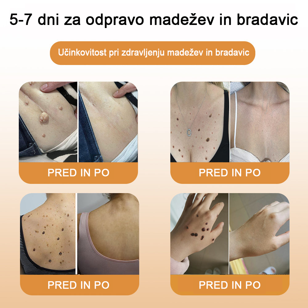 🌺𝙒𝙍𝙀𝙀™ Krema za odstranjevanje bradavic in oznak s čebeljim strupom (👨⚕Primerna za vse tipe kože)🐝(🔥Promocija zadnji dan 70% popust)