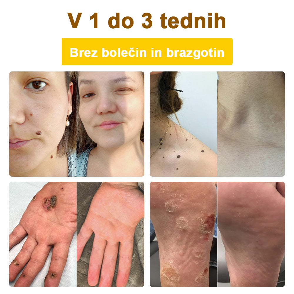 ✅flysmus™ zdravilna krema s čebeljim strupom🐝: Zdravljenje ekcemov, luskavice, aken, rozacee, glivičnih okužb, bradavic
