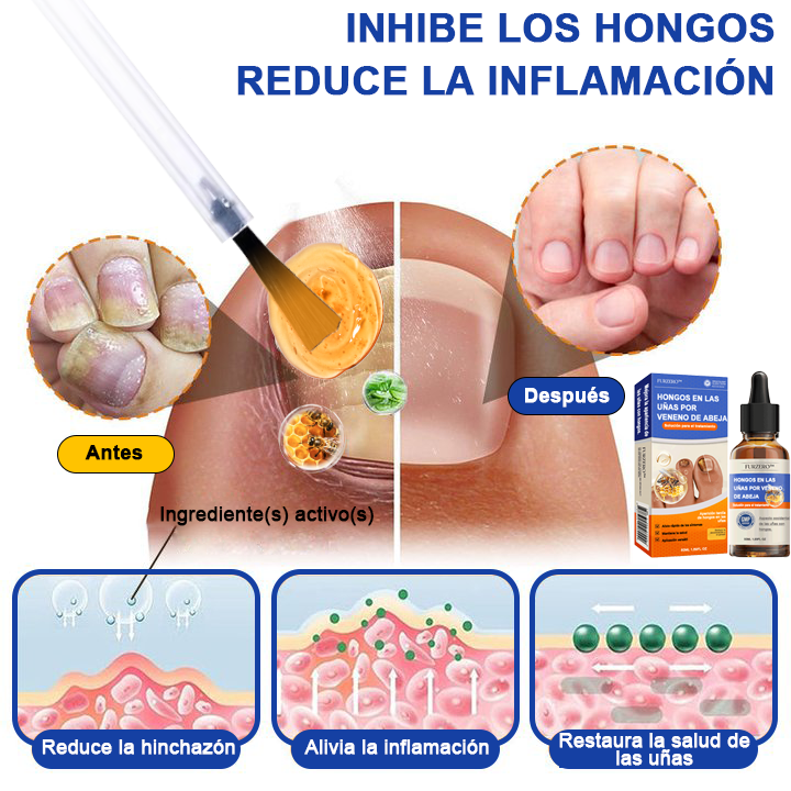 🐝🐝𝐅𝐮𝐫𝐳𝐞𝐫𝐨™Bienengift Nagelpilz Tretma: Popolna rešitev problema glivic na nohtih🌟👣
