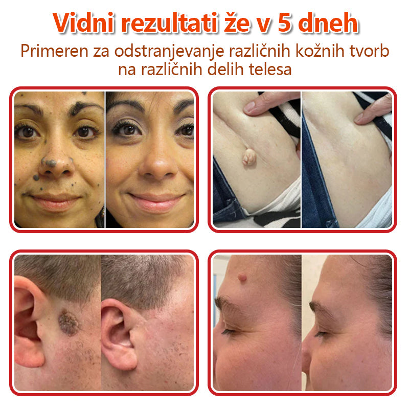 👨⚕️ GFOUK® MicroNeedle obliž za odstranjevanje kožnih izrastkov 🇪🇺 Skupno z EU smernicami za nego kože