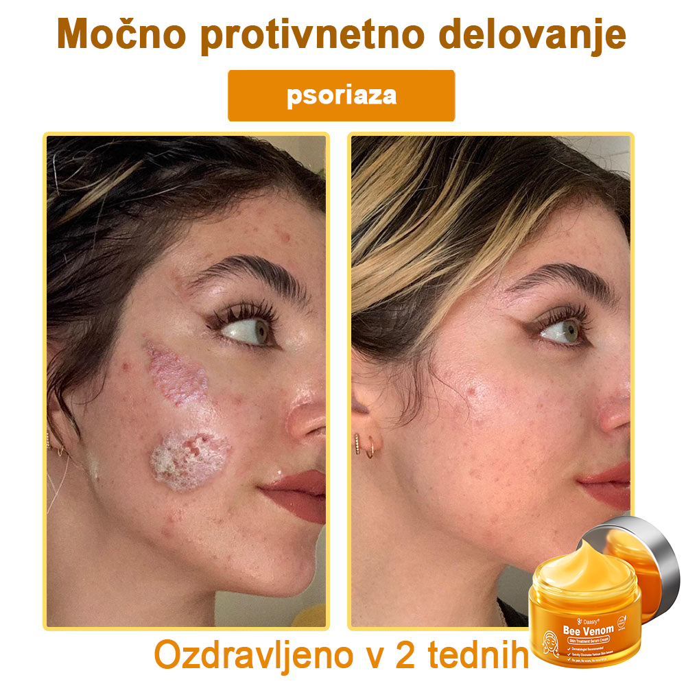 Daasry® Cebelji Strup Kožna Terapija Serum Krema👨⚕️ (Primerno za vse starosti & priporočeno s strani EMA)