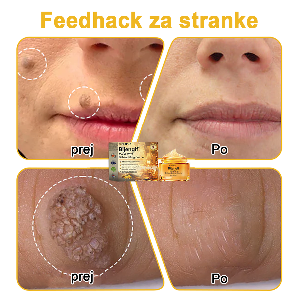 ✨🎁𝑭𝑹𝑶𝑷𝑼𝑵™ krema za odstranjevanje znamenj in madežev (85% popust zadnji dan dogodka)