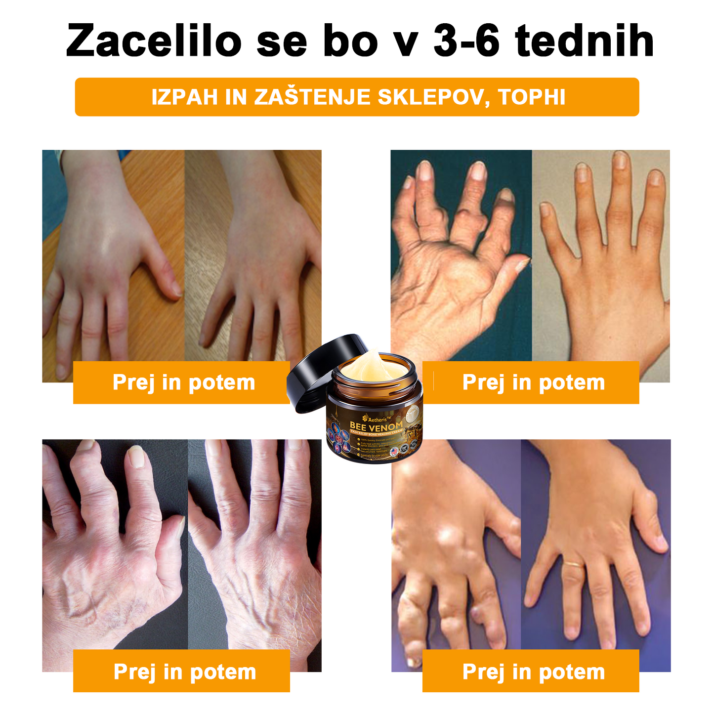 🔥 𝘈𝘦𝘵𝘩𝘦𝘳𝘪𝘴™ Krema za lajšanje artritisa s čebeljim strupom (posebej za starejše odrasle) 🦴– zadnji dan promocije: 70 % popusta 💪