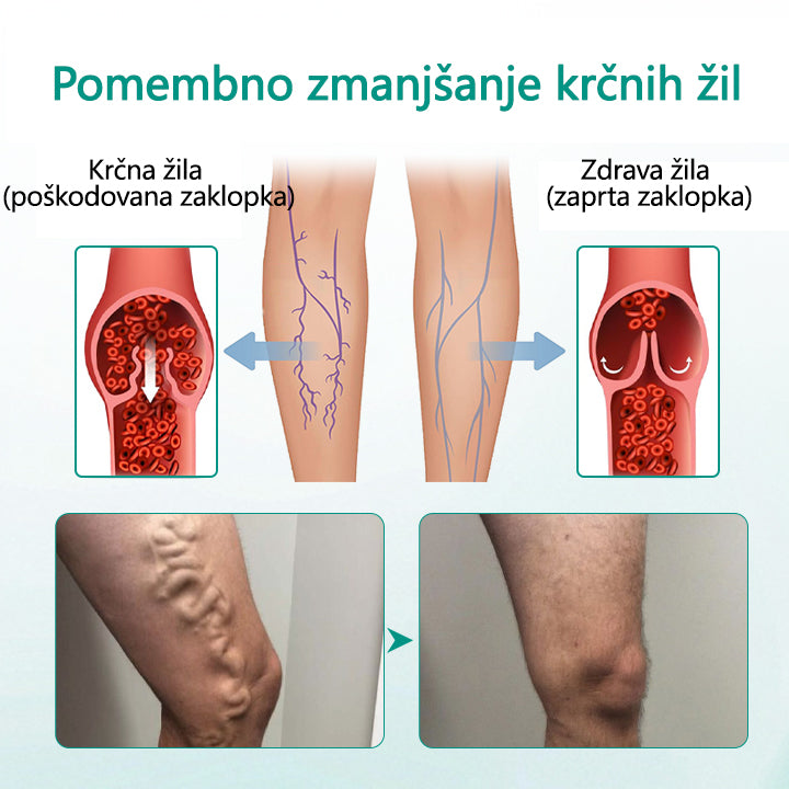 Timilk® LegRenew obliž za krčne žile izboljša zdravje ven in odpravi krčne žile – brez operacije